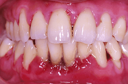 梅毒 歯茎 の 腫れ