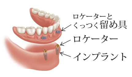 ロケーター義歯