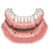 ロケーター義歯の特徴4