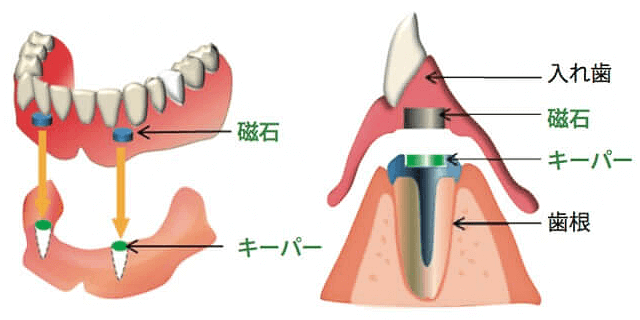 磁石の入れ歯の構造