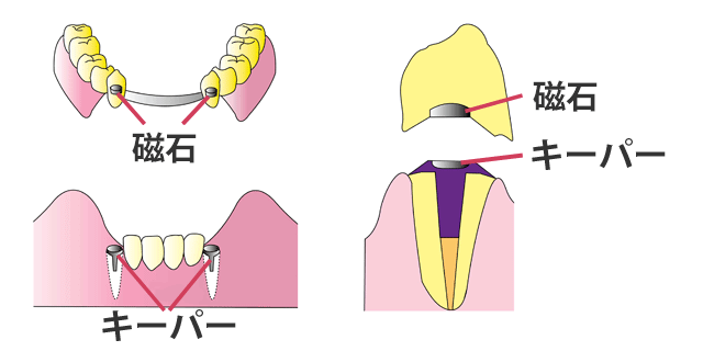 磁石の入れ歯の構造(部分入れ歯)