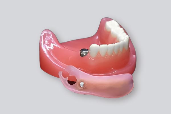 奥歯の入れ歯