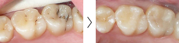 初期の虫歯（C1）の治療