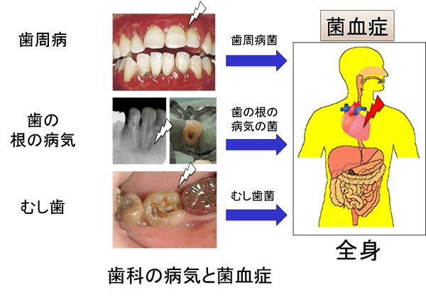 歯科の病気と菌血症