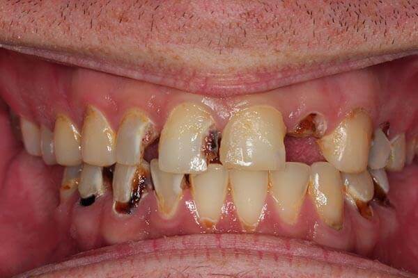 多数の虫歯