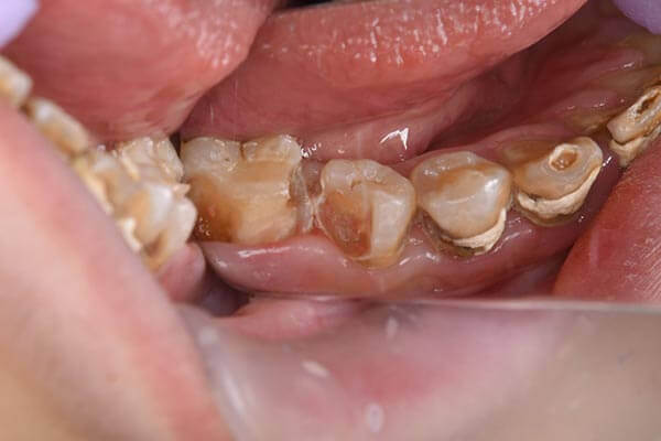 奥歯の歯と歯の間にある虫歯