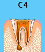 虫歯C4