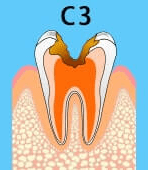 虫歯、C3