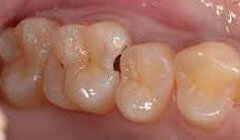 奥歯の歯と歯の間の虫歯