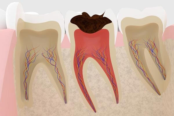 虫歯の神経治療について
