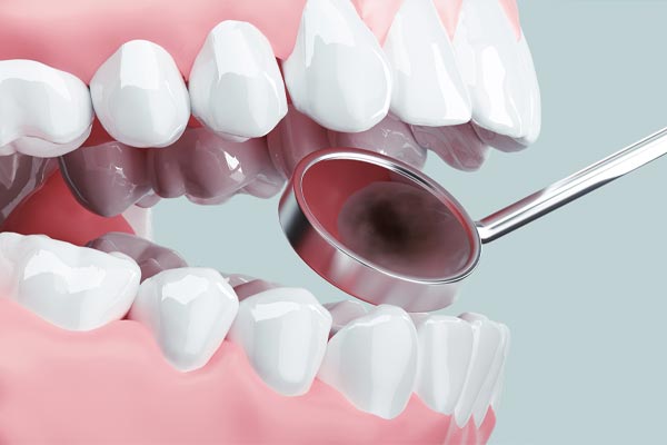 虫歯治療の流れ・治す方法