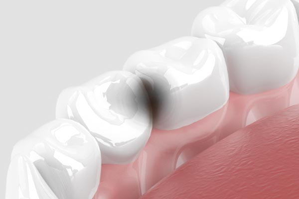 虫歯の初期について