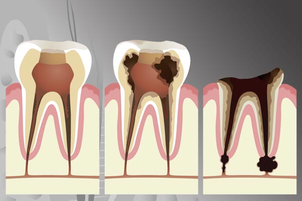 虫歯治療の流れ・治す方法