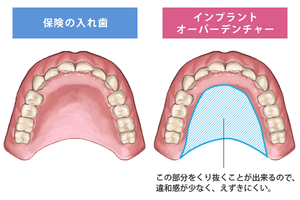 ꎕƃCvgI[o[f`[̔r