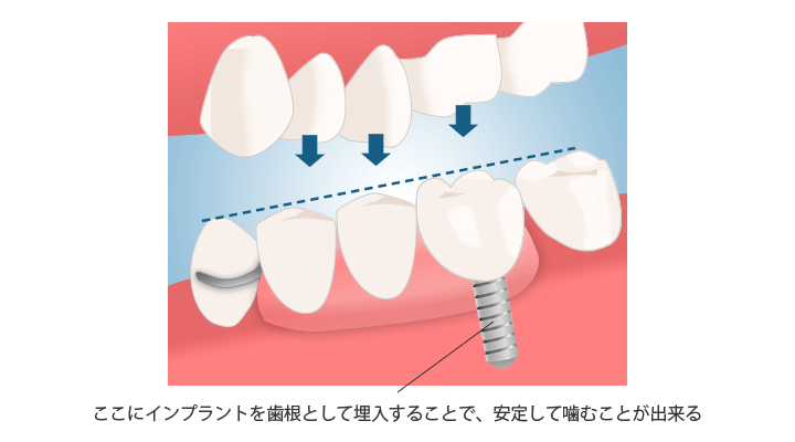 ꎕ̒ݍ݂Cvgŉ