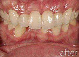 ガタガタの歯の症例写真：治療後