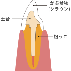 差し歯 の 仕組み