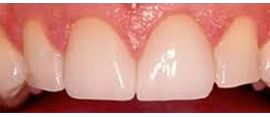 差し歯の色が変わった方のセラミック治療の症例写真：治療後