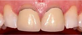 差し歯の色が変わった方のセラミック治療の症例写真：治療前