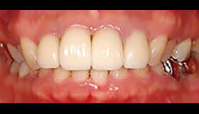 差し歯の色が変わった方のセラミック治療の症例写真：治療後