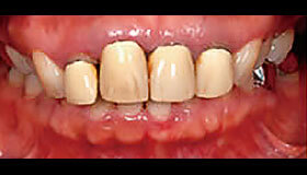 差し歯の色が変わった方のセラミック治療の症例写真：治療前
