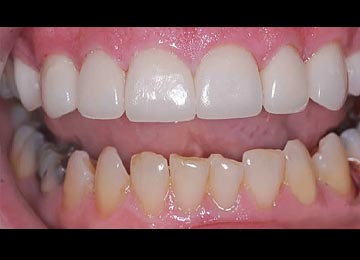 すきっ歯の症例写真：治療後