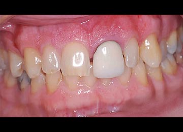 すきっ歯の症例写真：治療前