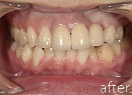 八重歯の症例写真：治療後
