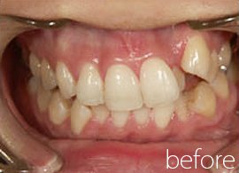 八重歯の症例写真：治療前