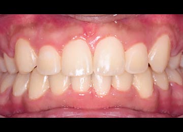 八重歯の症例写真：治療後