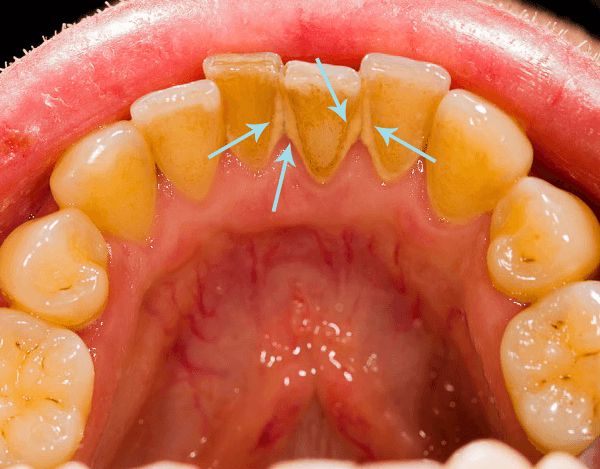 歯石取り専門サイト 痛くない歯石除去ならクローバー歯科 まつもと歯科