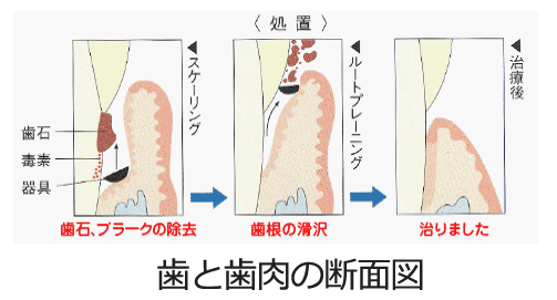 歯と歯肉の断面図